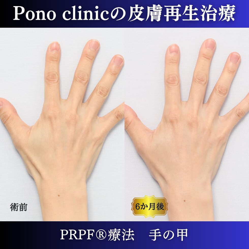 手の甲のゴツゴツ感、手の甲の若返り、PRPF療法、 40代の症例 (4)