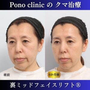 目の下のクマ、目の下のたるみ、裏ミッドフェイスリフト、裏ハムラ法、骨膜下リフト、50代の症例 (3)