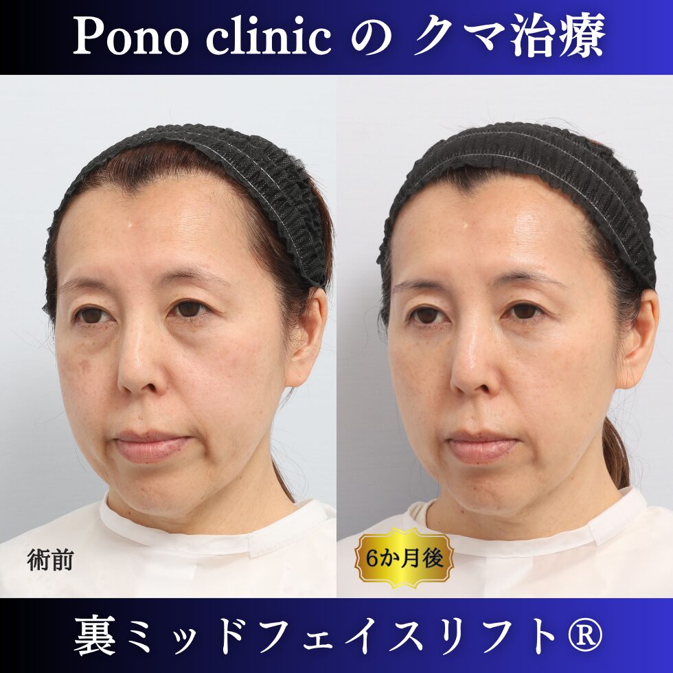 目の下のクマ、目の下のたるみ、裏ミッドフェイスリフト、裏ハムラ法、骨膜下リフト、50代の症例 (3)