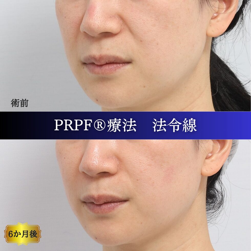 しわ治療、法令線、鼻翼基部、笑いじわ、PRPF療法、40代の症例 (2)