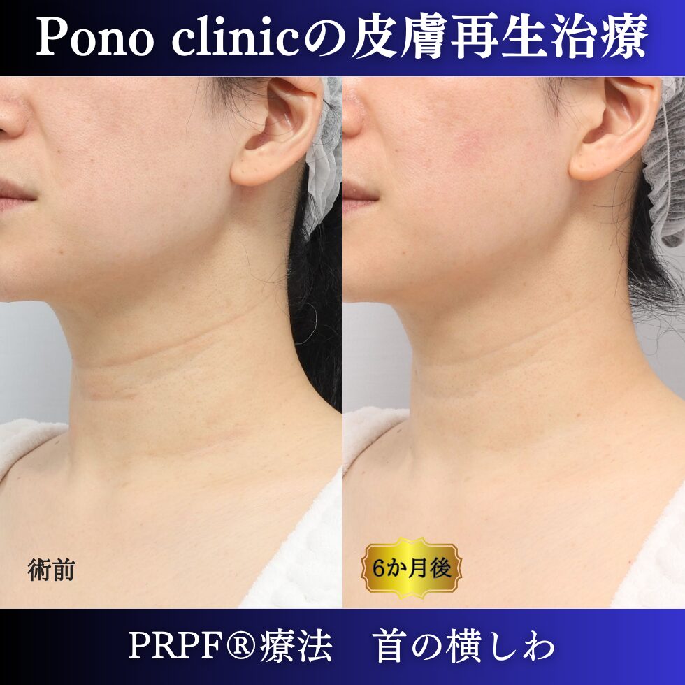 首のしわ、PRPF療法、40代の症例 (3)