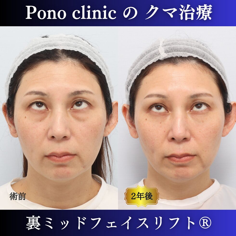 裏ミッドフェイスリフト、裏ハムラ法、骨膜下リフト、クマ治療、40代の症例、長期経過 (4)