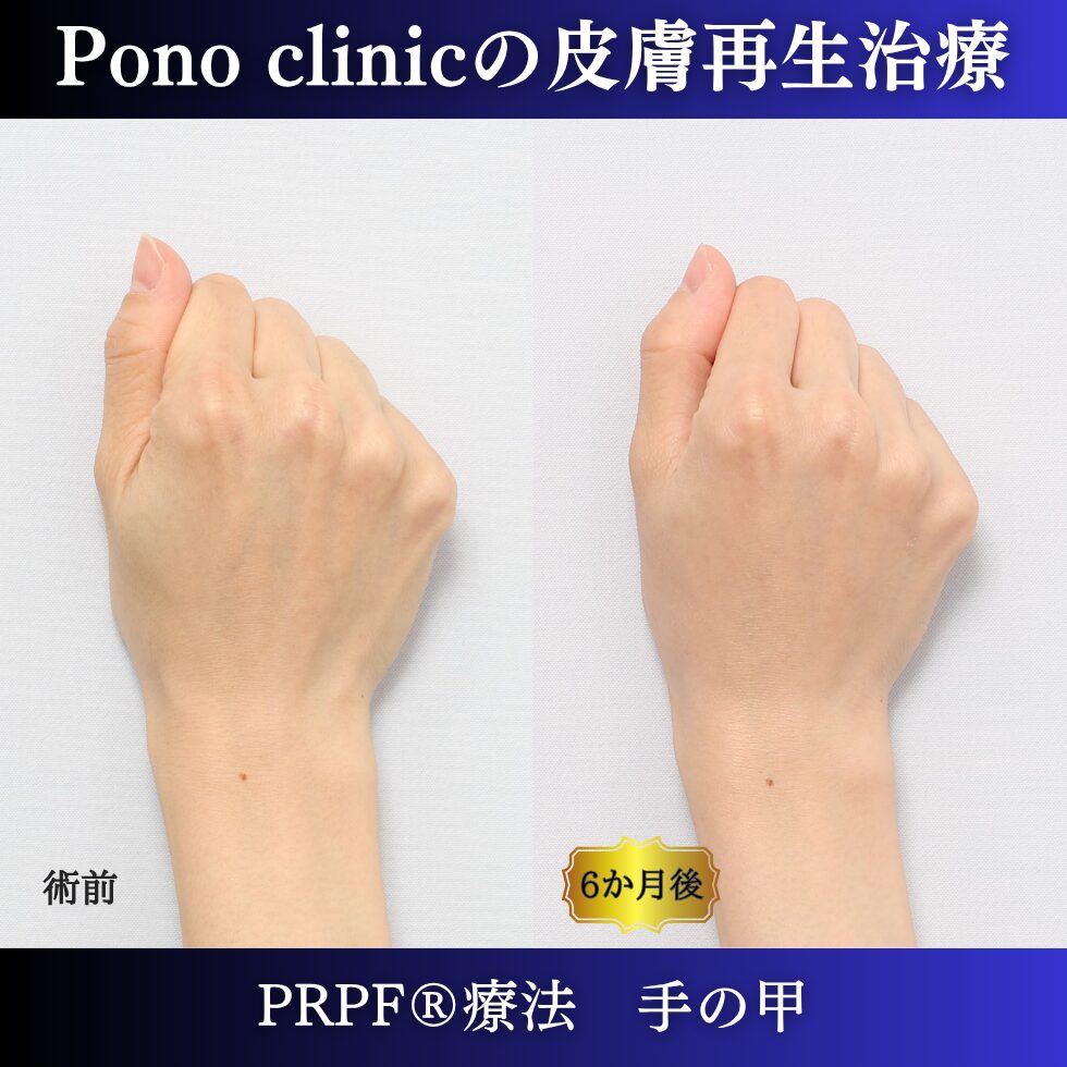 手の甲のゴツゴツ感、手の甲の若返り、PRPF療法、 40代の症例 (6)