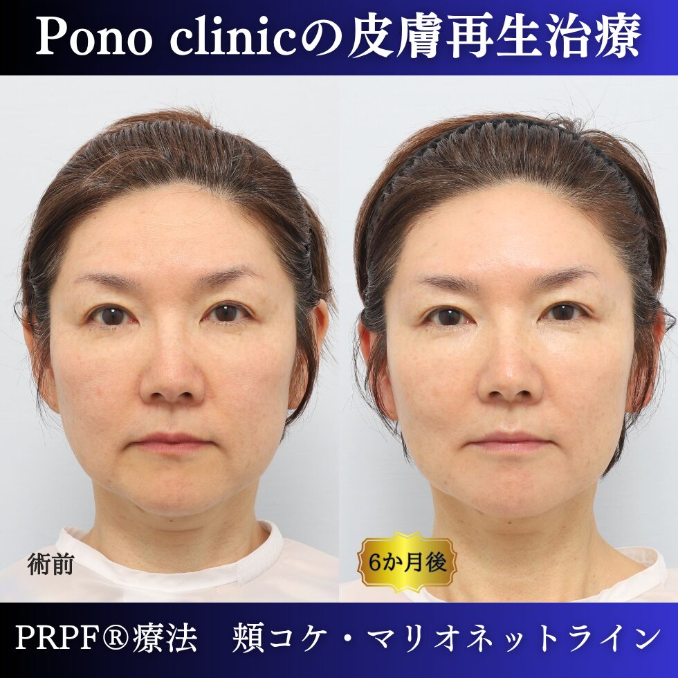 しわ治療、PRPF療法、マリオネットライン、頬コケ、50代の症例 (5)