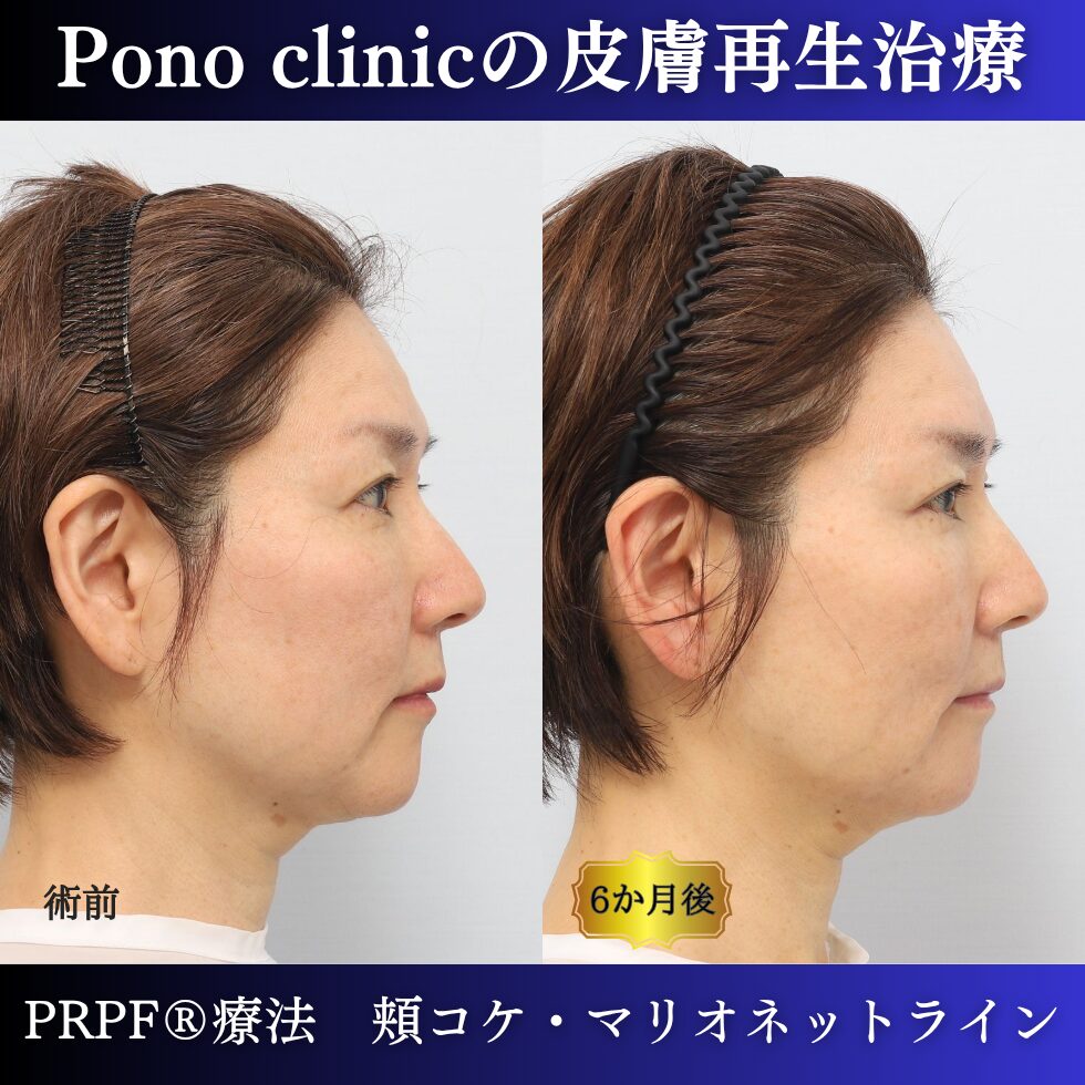 しわ治療、PRPF療法、マリオネットライン、頬コケ、50代の症例 (2)