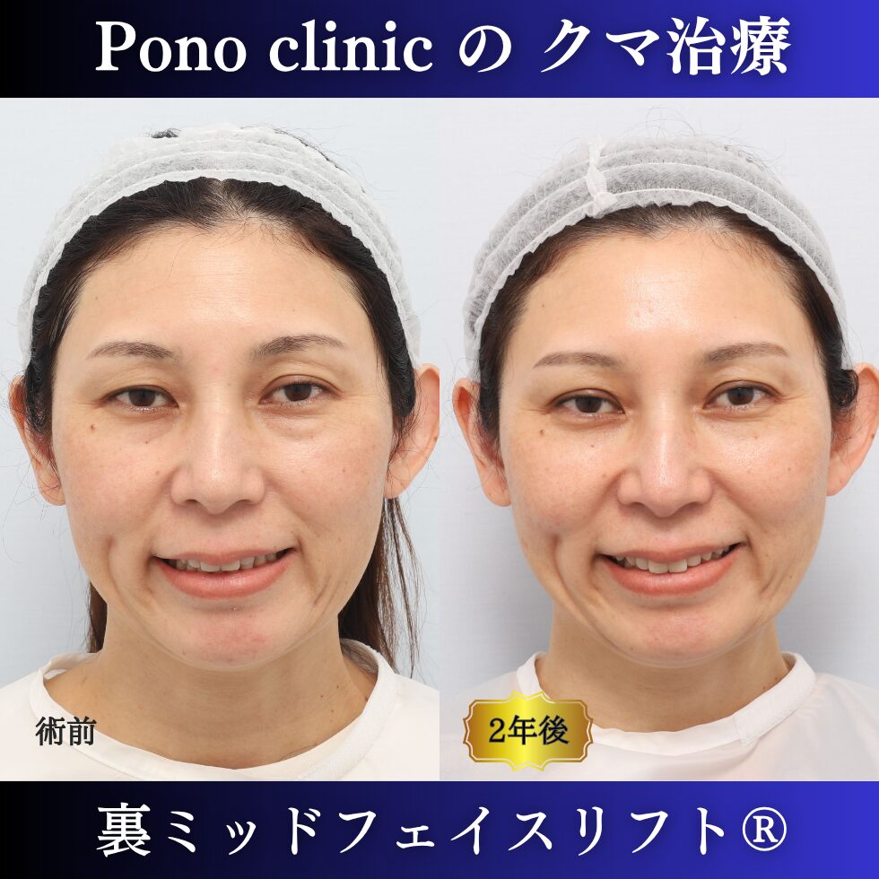 裏ミッドフェイスリフト、裏ハムラ法、骨膜下リフト、クマ治療、40代の症例、長期経過 (3)