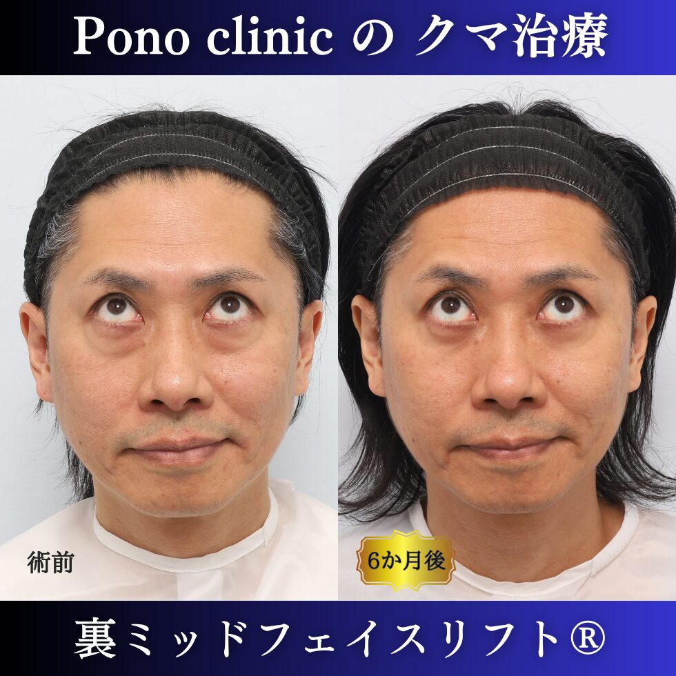 40代男性の裏ミッドフェイスリフト術前と術後6か月の上方視比較