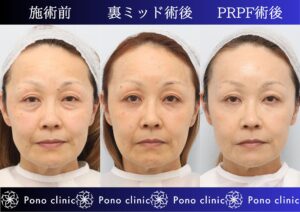 クマ治療、目の下のクマ、裏ハムラ、骨膜下リフト、裏ミッドフェイスリフト、PRPF療法 (1)