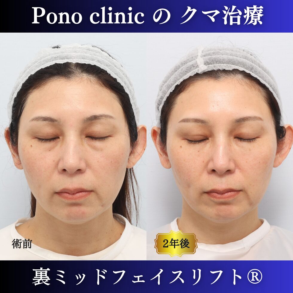 裏ミッドフェイスリフト、裏ハムラ法、骨膜下リフト、クマ治療、40代の症例、長期経過 (5)