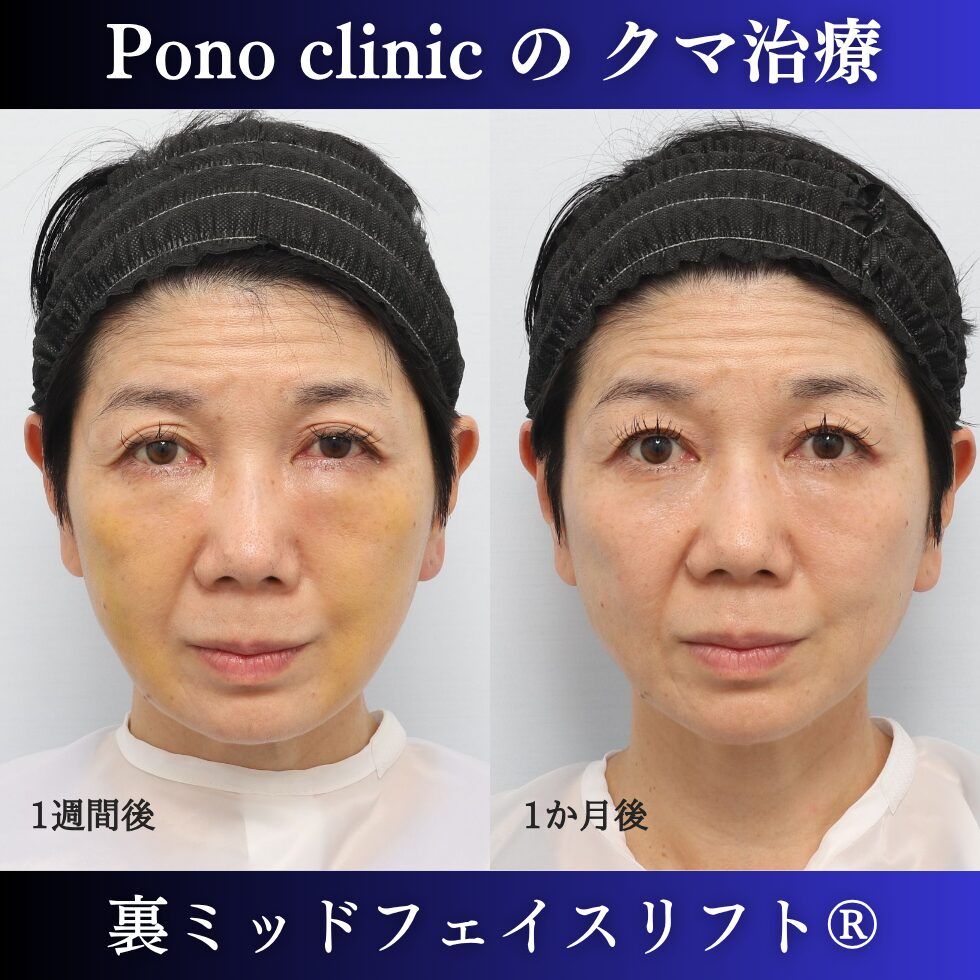 50代女性の裏ミッドフェイスリフト術後1週間と術後1か月の経過比較