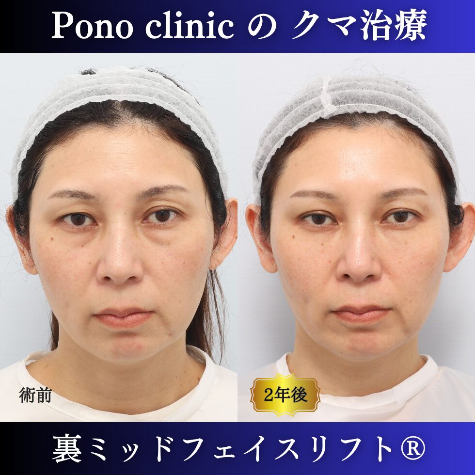 裏ミッドフェイスリフト、裏ハムラ法、骨膜下リフト、クマ治療、40代の症例、長期経過 (6)