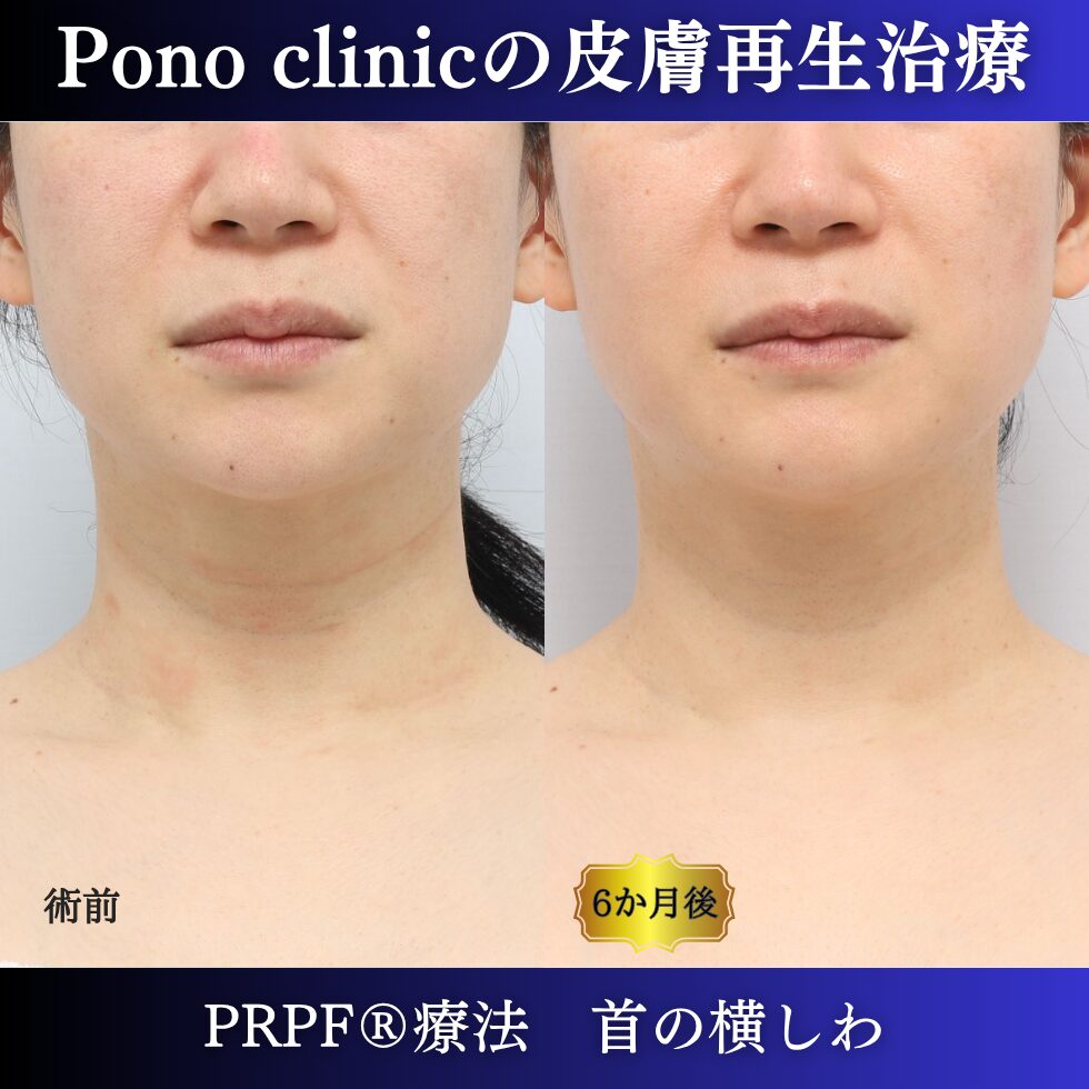 首のしわ、PRPF療法、40代の症例 (7)