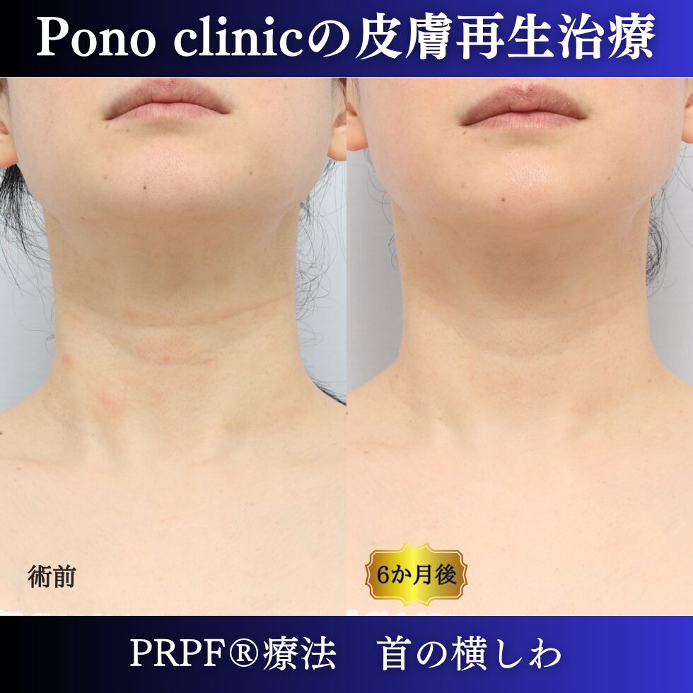首のしわ、PRPF療法、40代の症例 (6)