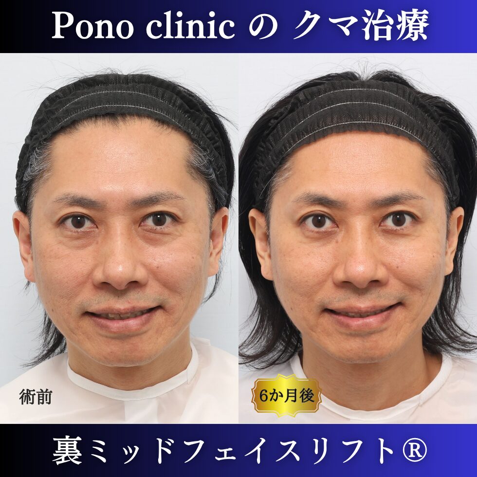 40代男性の裏ミッドフェイスリフト術前と術後6か月の笑顔比較