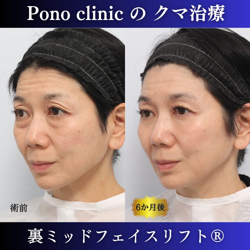 50代女性の裏ミッドフェイスリフト術前と術後6か月の左斜位比較