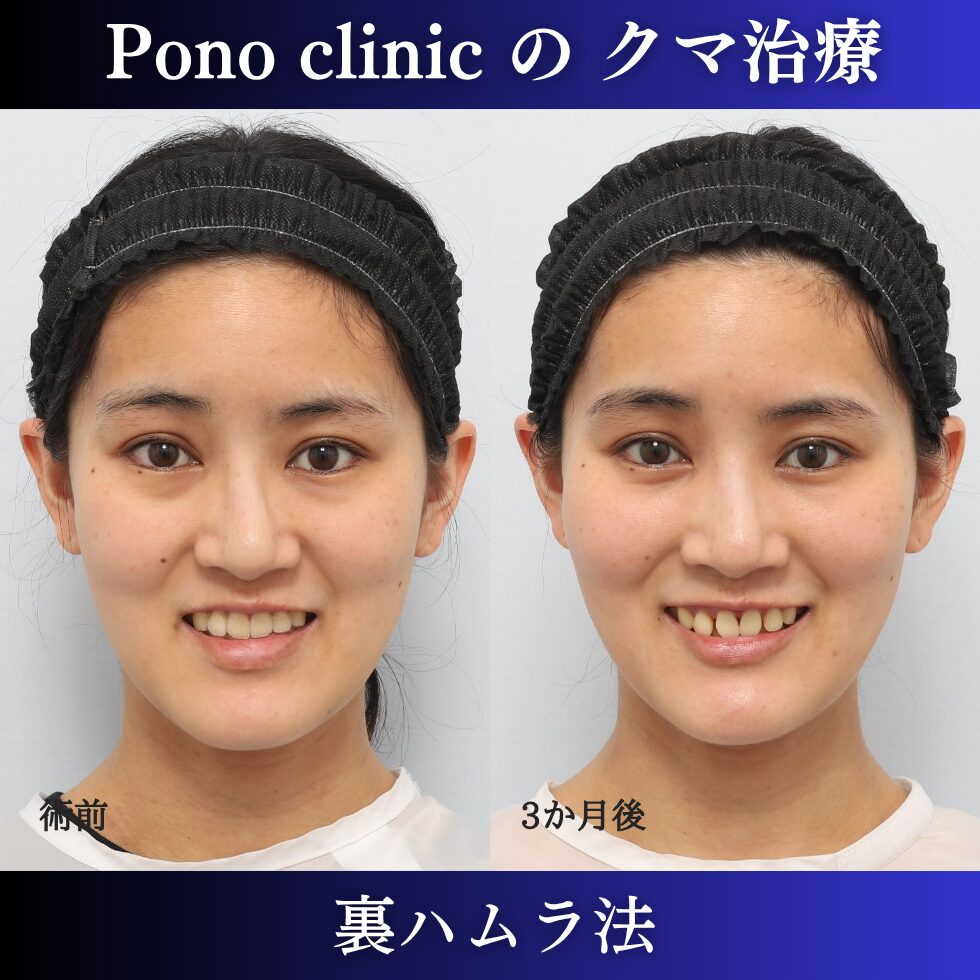 目の下のクマ取り、クマ治療、裏ハムラ法、20代女性の症例 (6)