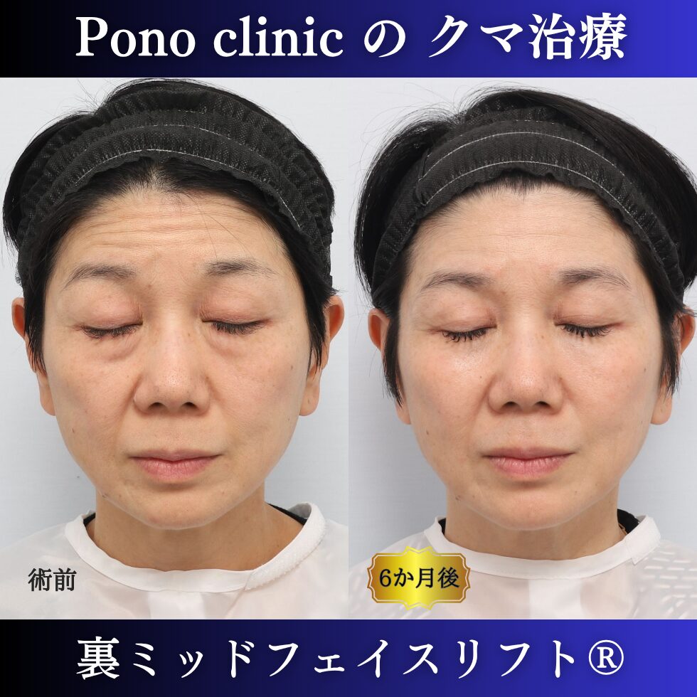 50代女性の裏ミッドフェイスリフト術前と術後6か月の閉眼比較