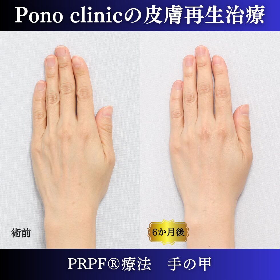 手の甲のゴツゴツ感、手の甲の若返り、PRPF療法、 40代の症例 (2)