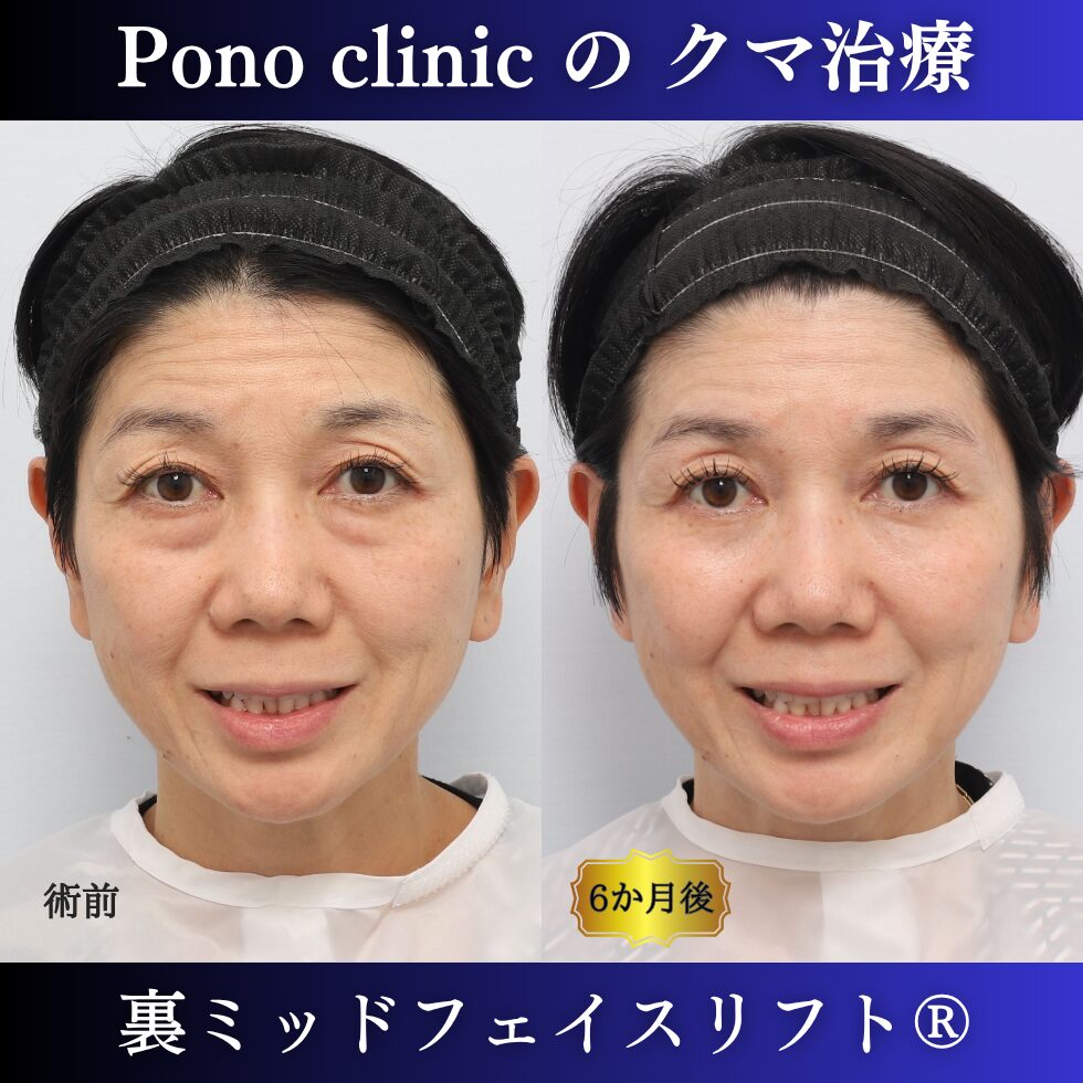 50代女性の裏ミッドフェイスリフト術前と術後6か月の笑顔比較