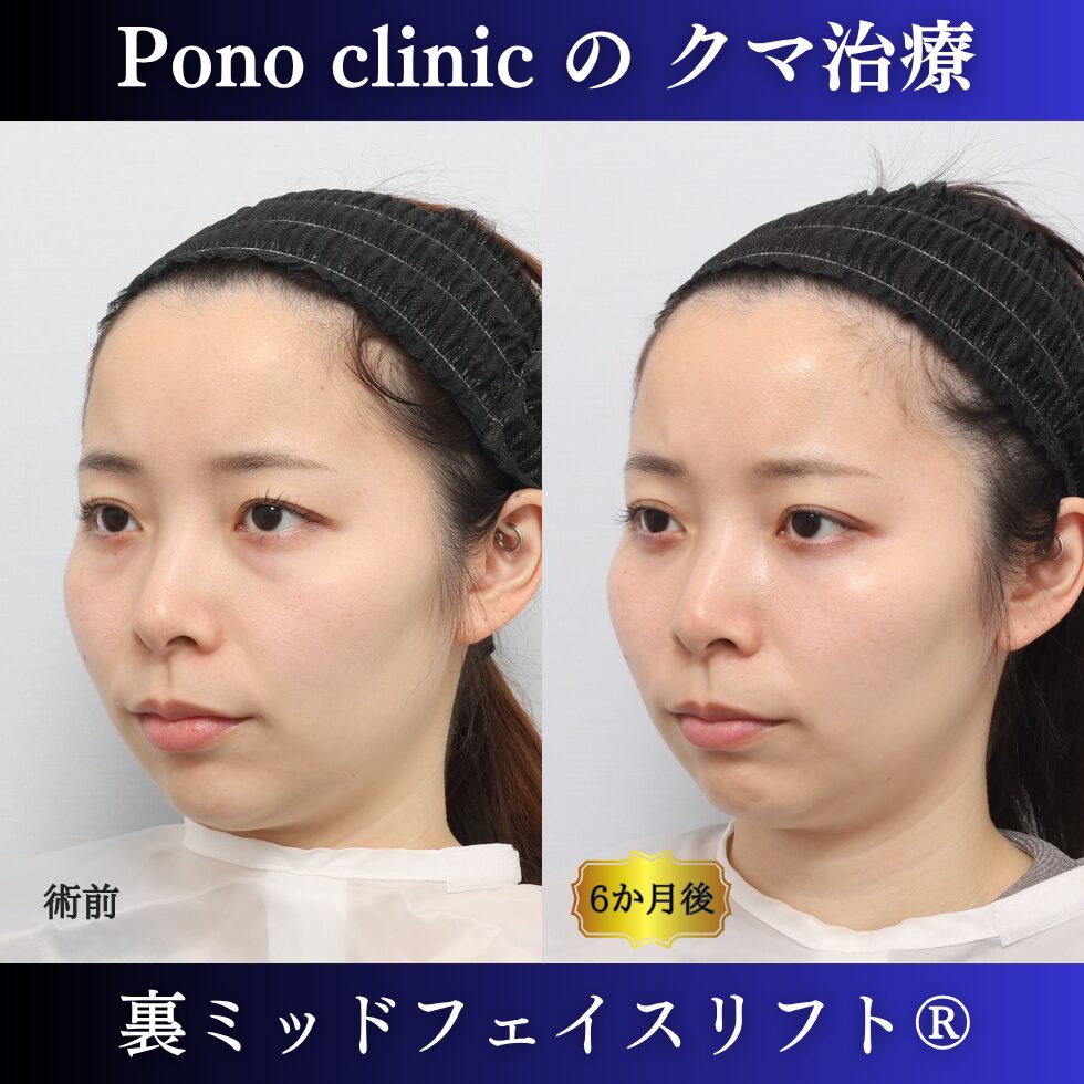 20代女性の裏ミッドフェイスリフト術前と術後6か月の左斜位比較