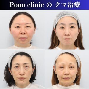 クマ治療、裏ミッドフェイスリフト、PRPF療法、女性の症例