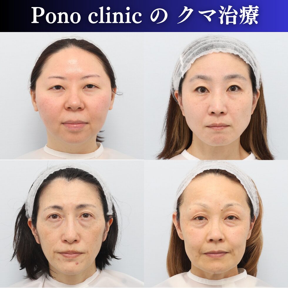 クマ治療、裏ミッドフェイスリフト、PRPF療法、女性の症例