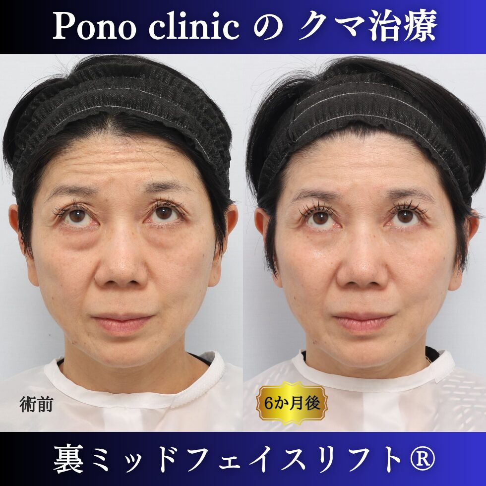 50代女性の裏ミッドフェイスリフト術前と術後6か月の上方視比較