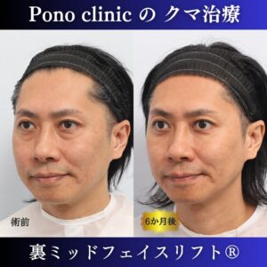 裏ミッドフェイスリフト、骨膜下リフト、裏ハムラ法、目の下のクマ取り、 40代男性の症例 (3)