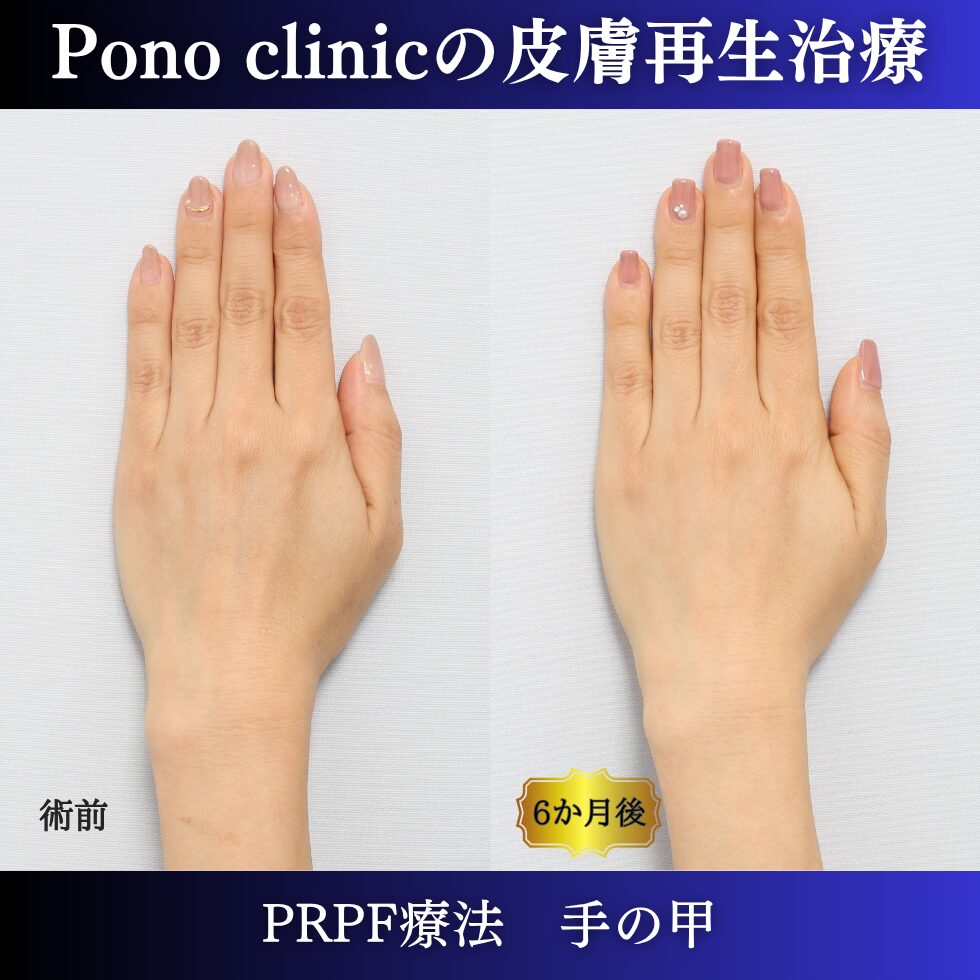 手の甲の若返り、手の甲のゴツゴツ感、PRPF療法 、50代の症例 (3)