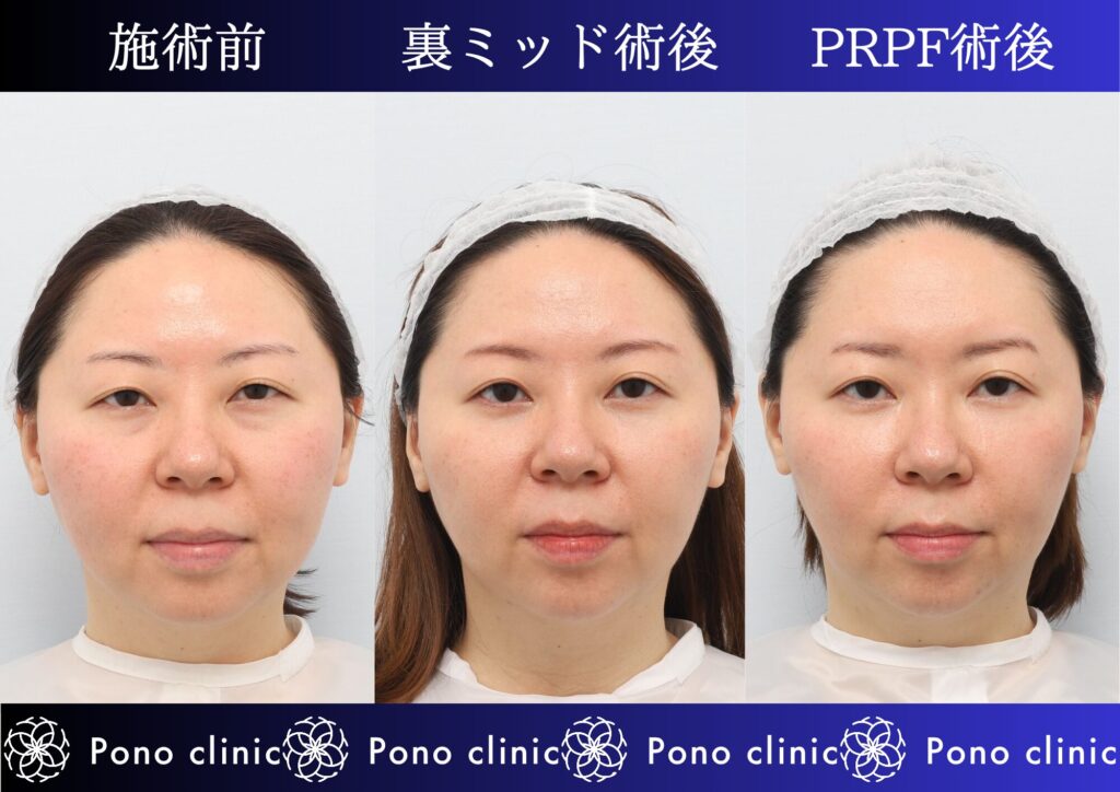 クマ治療、目の下のクマ、裏ハムラ、骨膜下リフト、裏ミッドフェイスリフト、PRPF療法 (4)