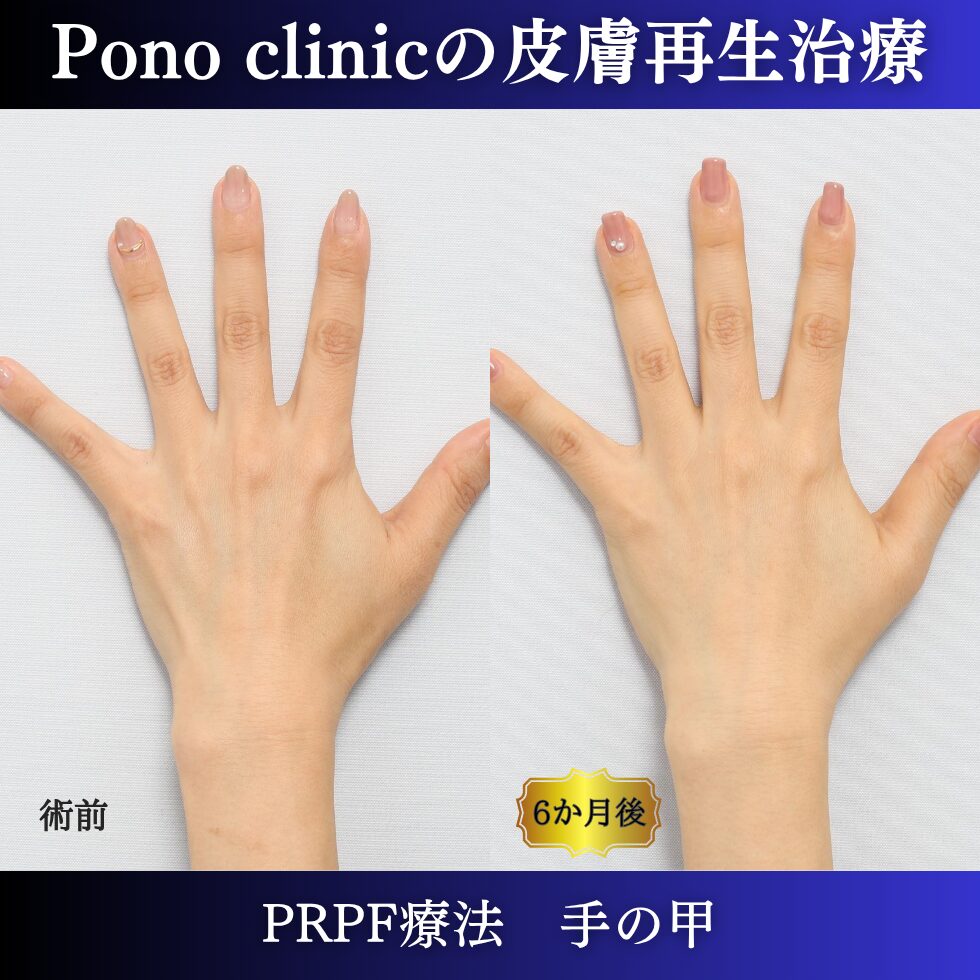 手の甲の若返り、手の甲のゴツゴツ感、PRPF療法 、50代の症例 (2)