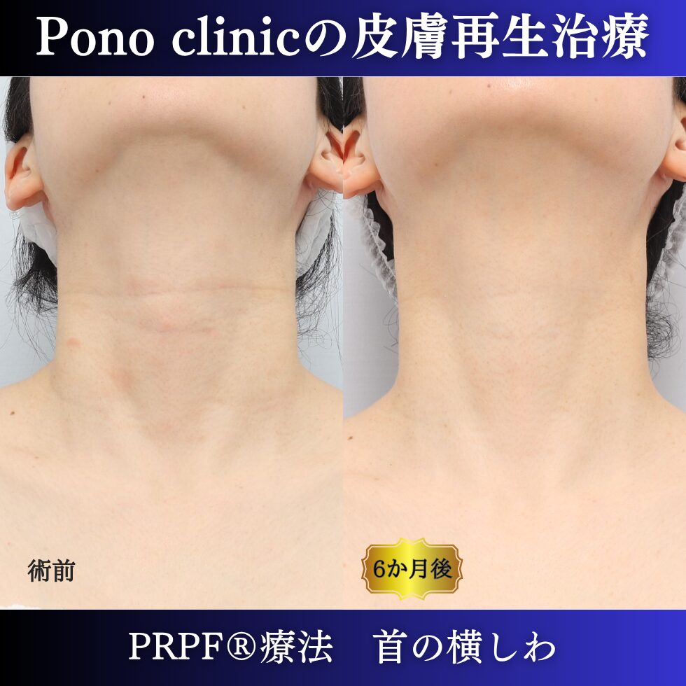 首のしわ、PRPF療法、40代の症例 (5)