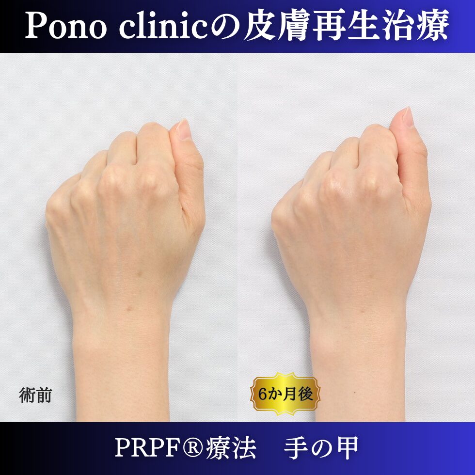 手の甲のゴツゴツ感、手の甲の若返り、PRPF療法、 40代の症例 (3)
