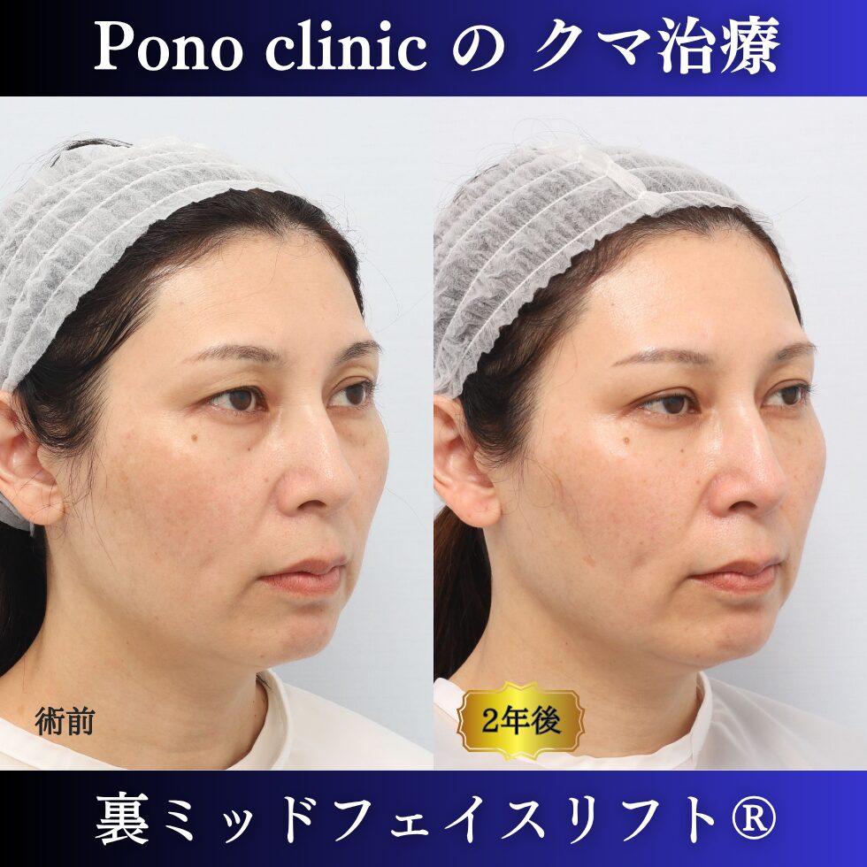 裏ミッドフェイスリフト、裏ハムラ法、骨膜下リフト、クマ治療、40代の症例、長期経過 (1)