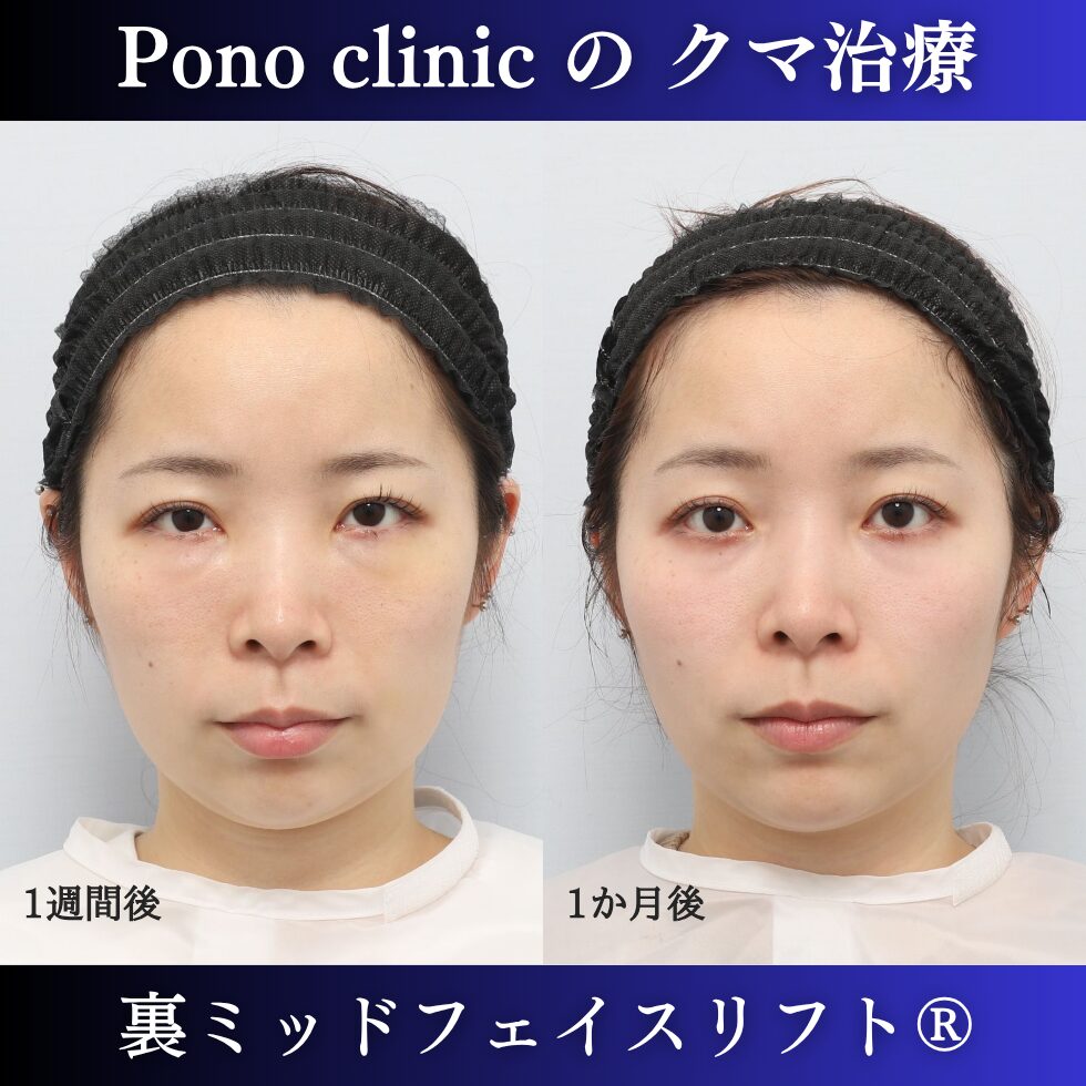 20代女性の裏ミッドフェイスリフト術後1週間と術後1か月の経過比較