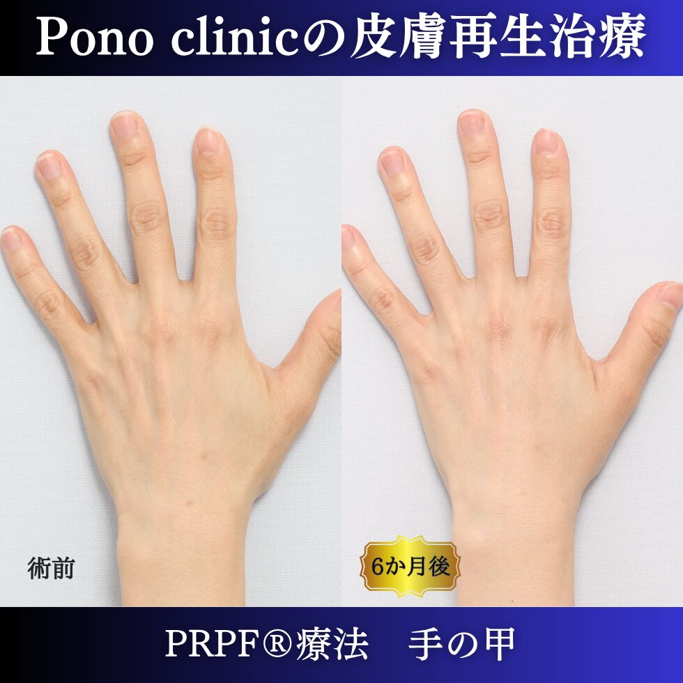 手の甲のゴツゴツ感、手の甲の若返り、PRPF療法、 40代の症例 (1)
