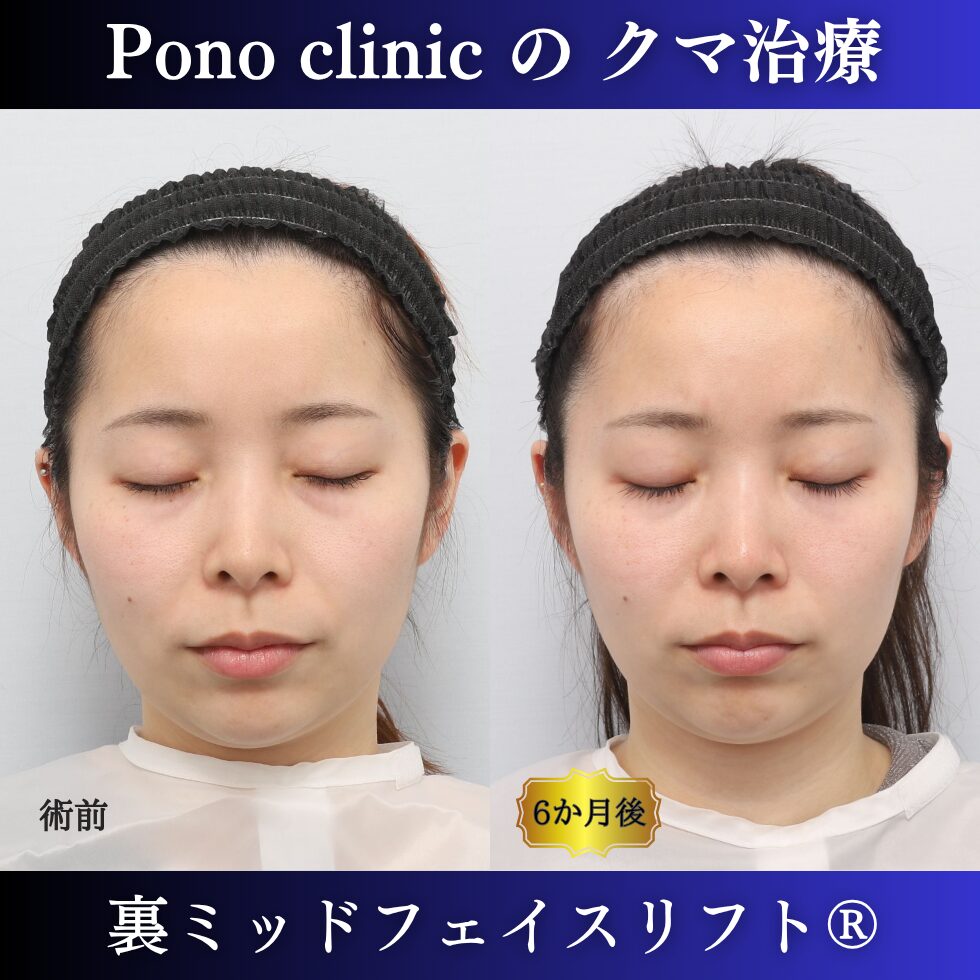 20代女性の裏ミッドフェイスリフト術前と術後6か月の閉眼比較