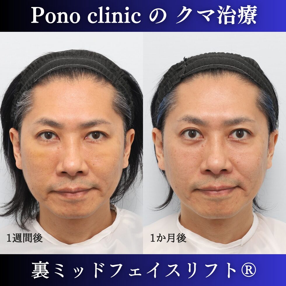 40代男性の裏ミッドフェイスリフト術後1週間と術後1か月の経過比較
