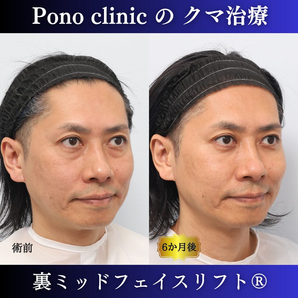40代男性の裏ミッドフェイスリフト術前と術後6か月の右斜位比較
