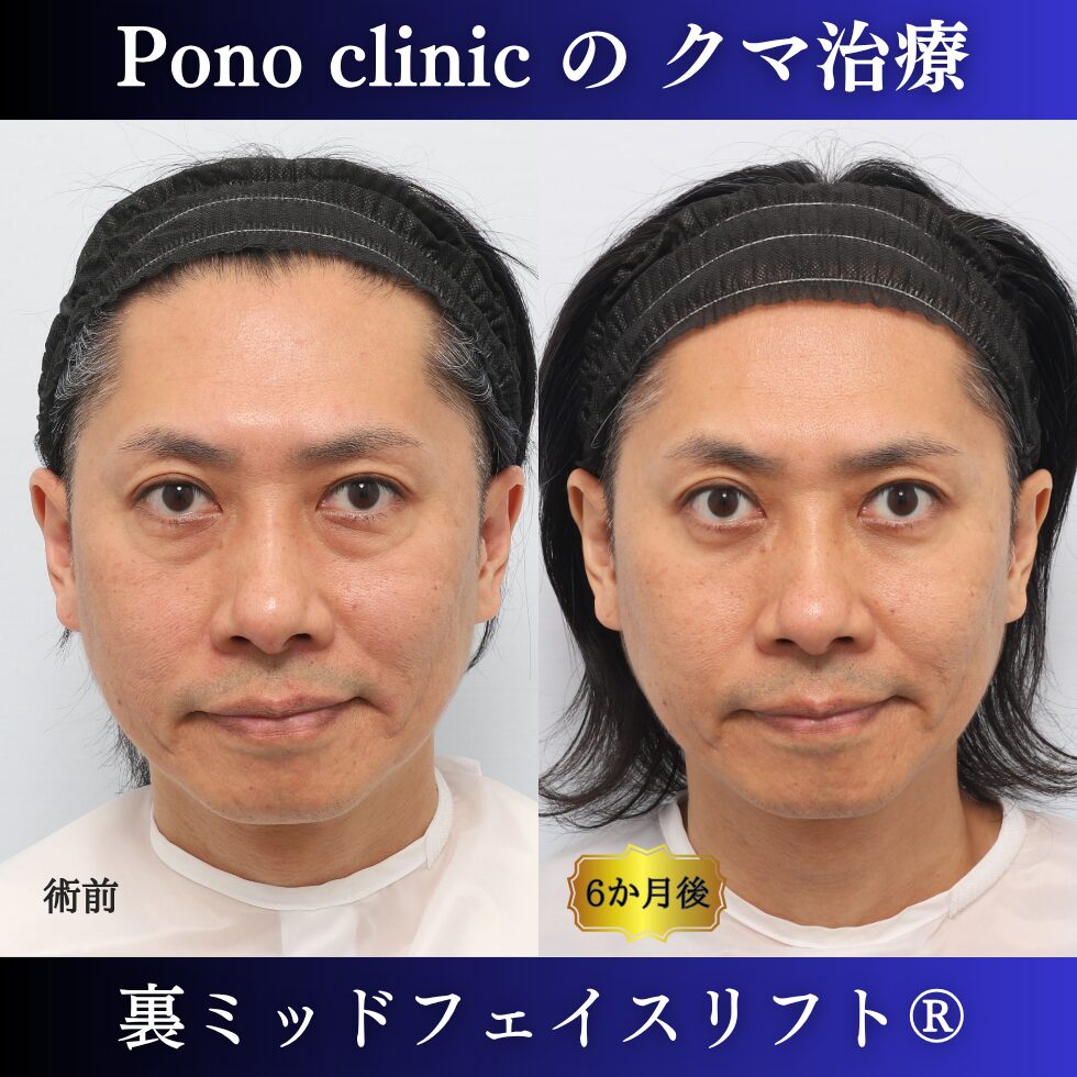 40代男性の裏ミッドフェイスリフト術前と術後6か月の正面比較