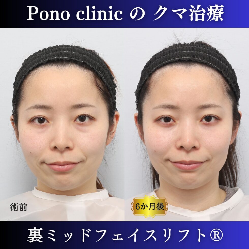 20代女性の裏ミッドフェイスリフト術前と術後6か月の笑顔比較