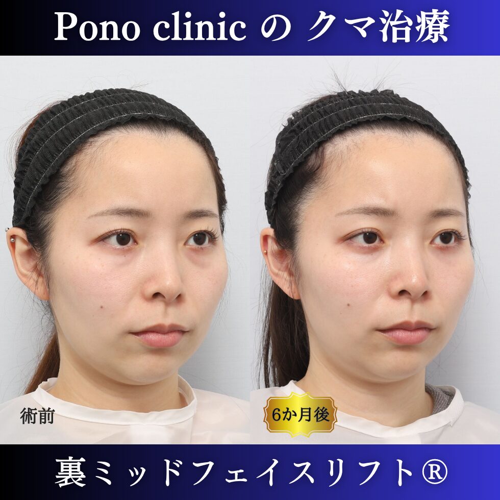 20代女性の裏ミッドフェイスリフト術前と術後6か月の右斜位比較