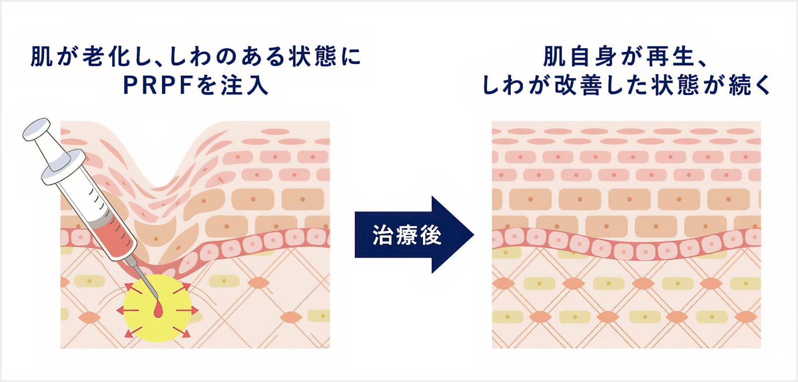 PRPF療法で皮膚のハリや質感を整えるイメージ