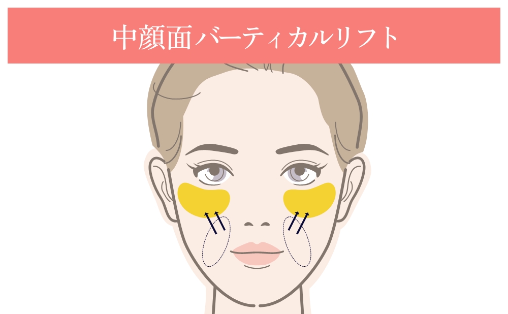 中顔面バーティカルリフトで頬の重心を整えるイメージ