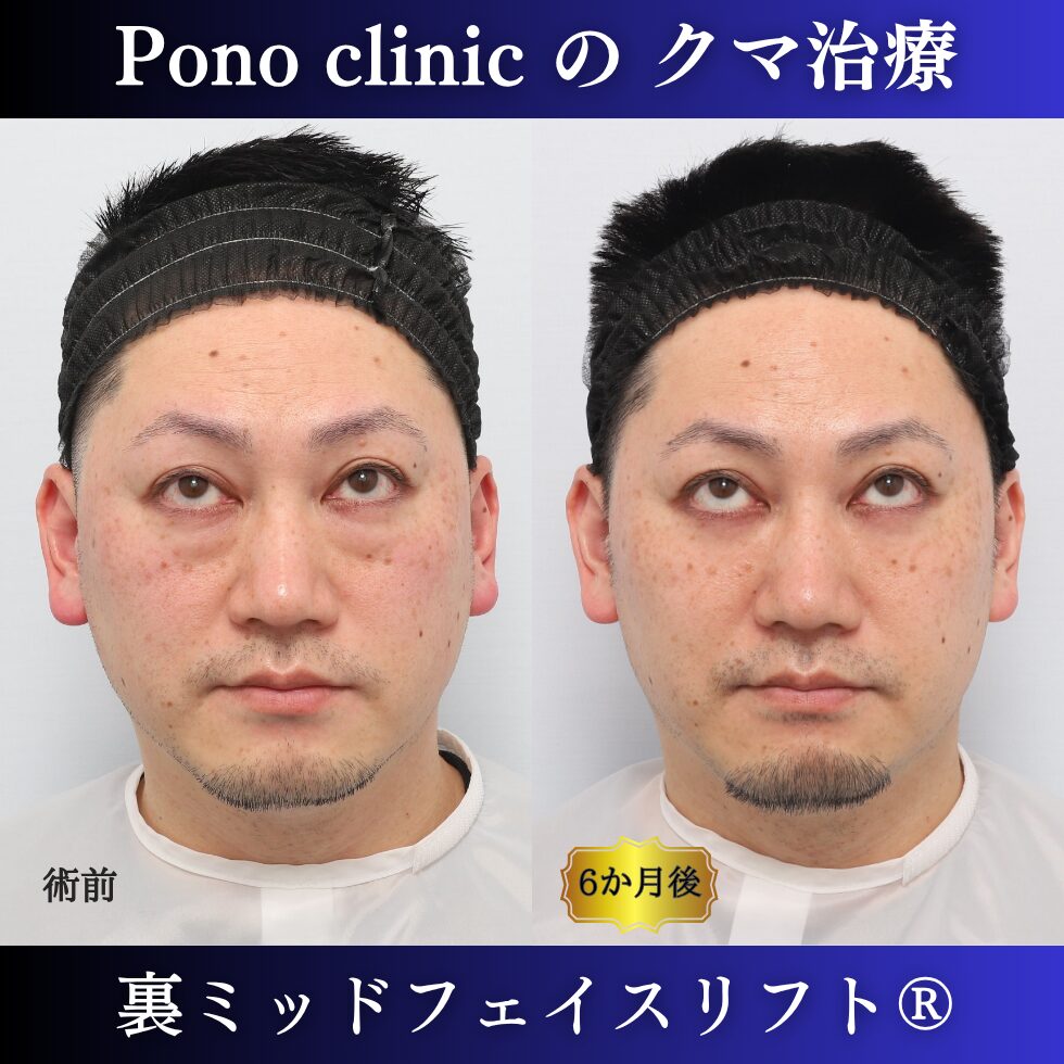 40代男性の裏ミッドフェイスリフト術前・術後の上方視比較