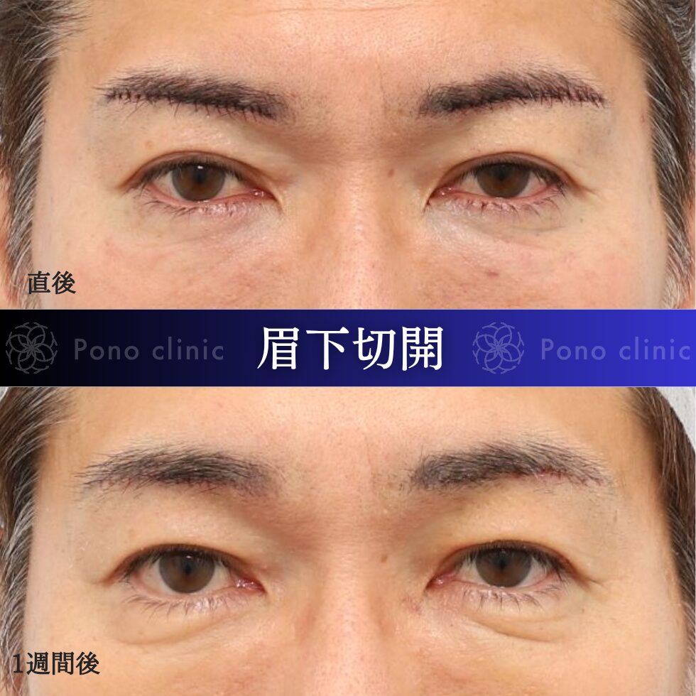 眉下切開、眉下リフト、目の上のたるみ、50代男性 (4)