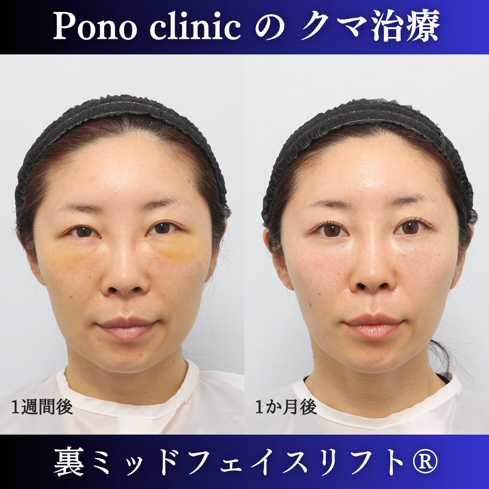目の下のクマ、クマ治療、裏ハムラ、骨膜下リフト、裏ミッドフェイスリフト、30代の症例 (1)
