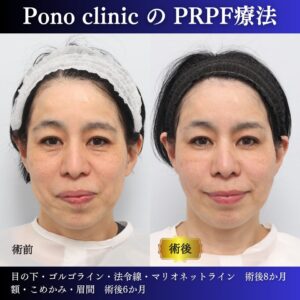 しわ治療、クマ治療、PRPF®療法　、目の下・ゴルゴライン・法令線・マリオネットライン・額・こめかみ・眉間、50代の症例 (5)
