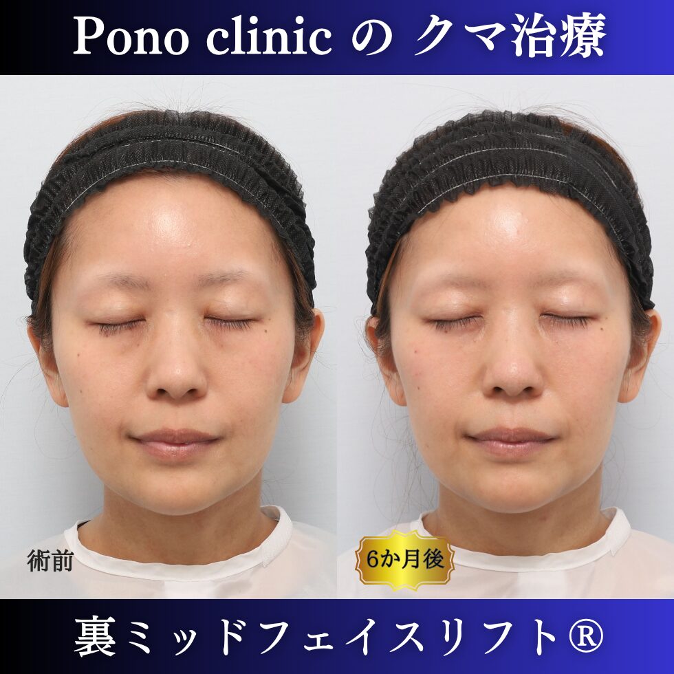 30代女性の裏ミッドフェイスリフト術前・術後の閉眼時比較