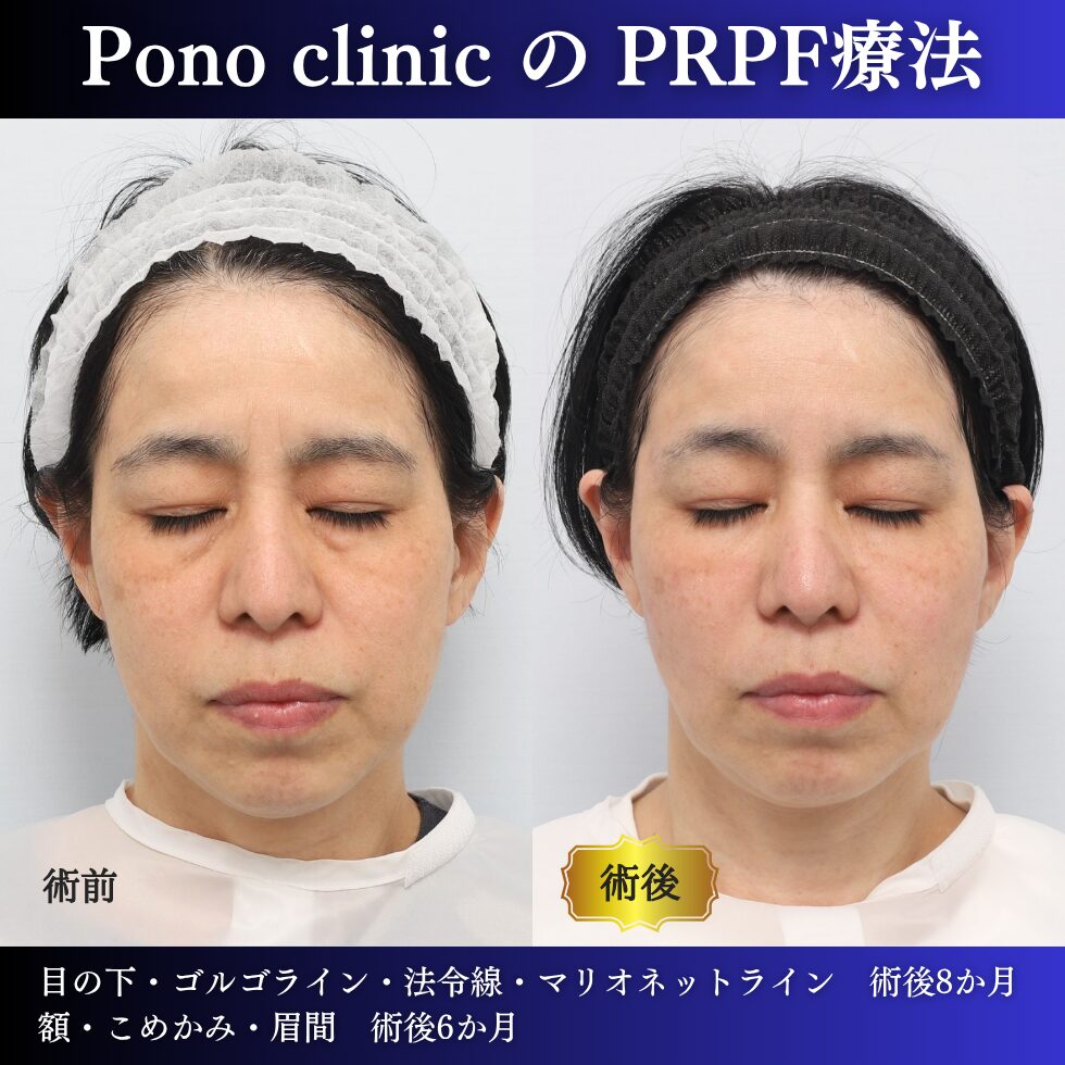 50代女性のPRPF®療法閉眼・治療前治療後比較